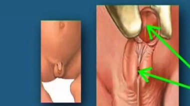 Chirurgie des testicules chez l'enfant