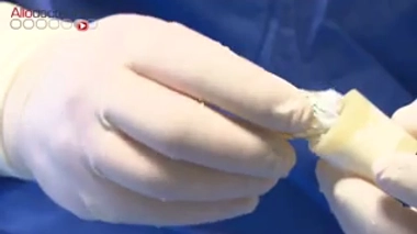 Comment les stents sont-ils fabriqués ?