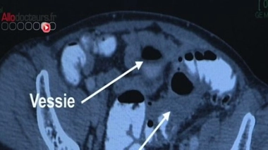 Diverticulose du côlon : une question de fibres !