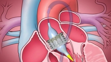 Un test biologique rapide pour valider le succès de l'implantation d'une valve cardiaque