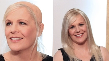 Chute de cheveux : la dermofusion pour une nouvelle chevelure