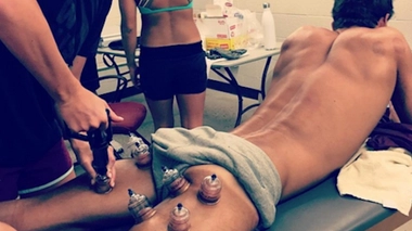 Le cupping ou la ventousothérapie, qu'est-ce que c'est ?