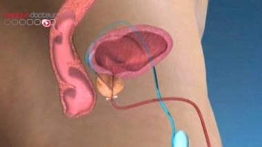 Cancer de la prostate : l'hormonothérapie améliorerait les chances de survie lors d'une récidive