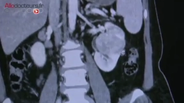 Recherche : mieux comprendre les tumeurs du rein