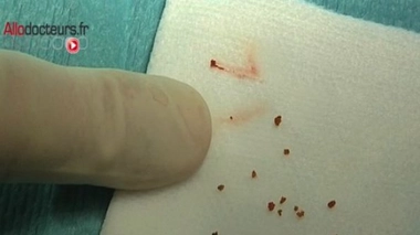 Calculs rénaux : les réponses à vos questions sur notre Facebook Live