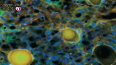 Certains cancers métastasent-ils plus lorsque l'on mange très gras ?