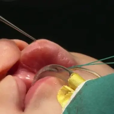 Fente labio-palatine : le bec de lièvre