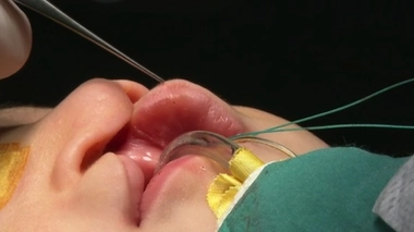 Fente labio-palatine : le bec de lièvre