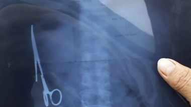 photographie de la radio de l'estomac © MAXPPP/STRINGER/EPA .jpg