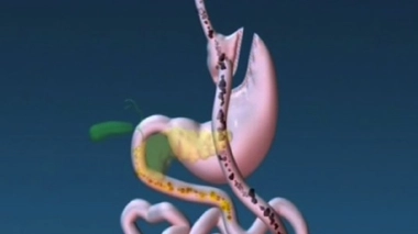 By-pass gastrique : efficace à long terme chez l'adolescent