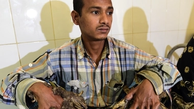 Abul Bajandar avant ses opérations (DR).