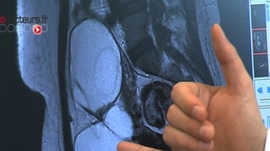 La structure d'un cervelet en formation retrouvée dans un ovaire - Image d'illustration (kyste ovarien)