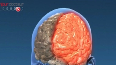 Migraines : un risque accru d'AVC après une intervention chirurgicale ?