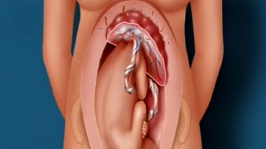 Les greffes d'utérus ont permis la naissance de quatre enfants en Suède