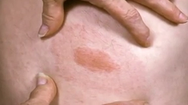 Maladie de Lyme : une plainte pénale incrimine la fiabilité des tests de dépistage