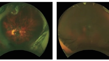 DMLA : trois femmes perdent la vue à l'issue d'un essai clinique non homologué