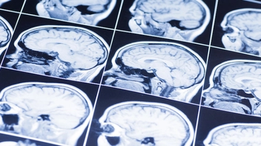 Neurones : un venin d'araignée peut empêcher leur mort après un AVC - 