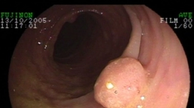 Existe-t-il un lien entre forte consommation d’antibiotiques et apparition de polypes intestinaux ? (Image d'illustration)