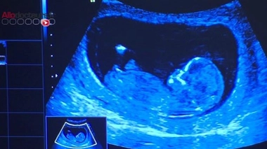 Trisomie 21 non détectée : le CHU de Limoges condamné