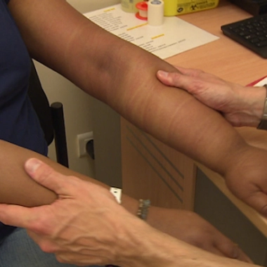 Le lymphoedème conduit à un gonflement des membres.