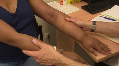 Le lymphoedème conduit à un gonflement des membres.