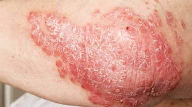 Comment soigner l'eczéma de l'enfant ?