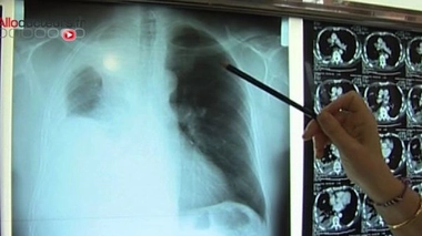 Le mésothéliome est une forme rare et virulente de cancer, lié à l'amiante, qui affecte l'enveloppe des poumons.