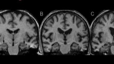 Alzheimer en questions