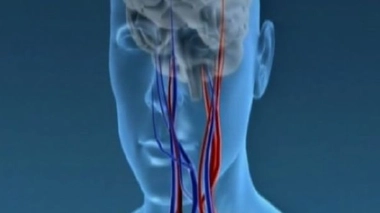 Carotides, des artères à surveiller