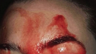 La patiente semble "suer du sang" : un cas d'hématidrose publié dans le Canadian Medical Association Journal