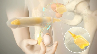 Pour en finir avec le tabou de la prothèse pénienne