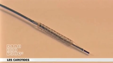 Carotides : une artère rebouchée malgré un stent ?
