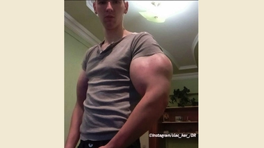 Kirill s’est injecté de l’huile de synthol dans les bras pendant dix jours.