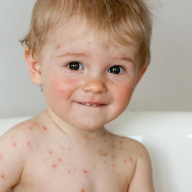 Maladies éruptives : comment les reconnaître ?