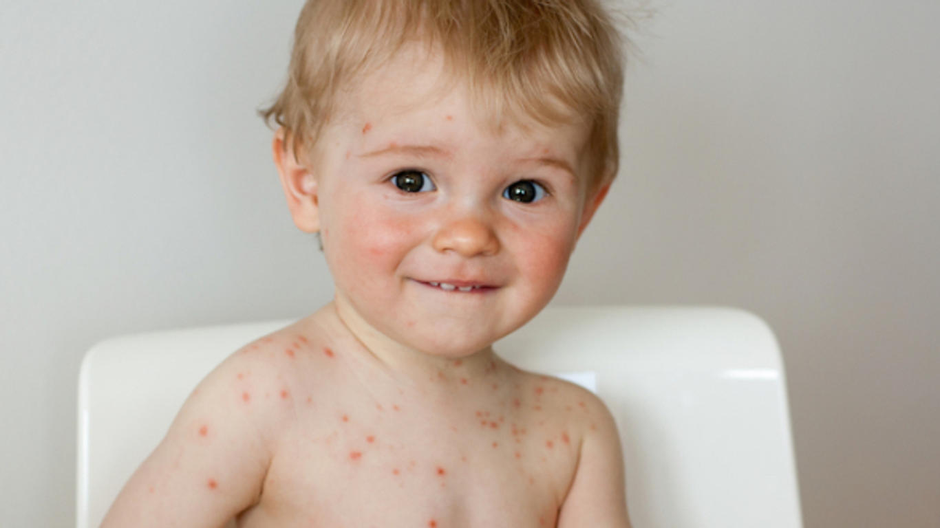 Maladies éruptives : comment les reconnaître ? - Allo Docteurs