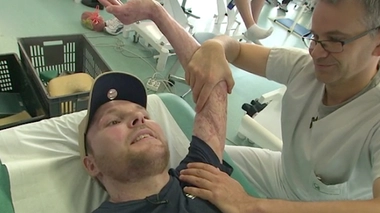 Frank, brûlé sur 95 % de son corps, a été sauvé par une greffe de peau de son frère jumeau