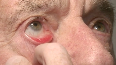 Ectropion : quand la paupière inférieure s'affaisse