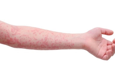 90% des cas sont survenus chez des sujets non ou mal vaccinés