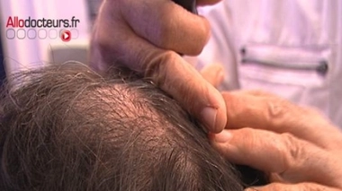  Les chercheurs ont réussi à cultiver 5 000 "germes de follicules pileux" en quelques jours.