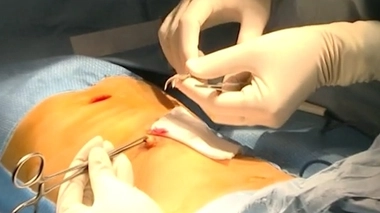 La moitié (49%) des opérations étudiées étaient des interventions d’urgence, parmi lesquelles un tiers de retrait d’appendice (illustration) et un peu plus d’un tiers de retrait de vésicule biliaire.