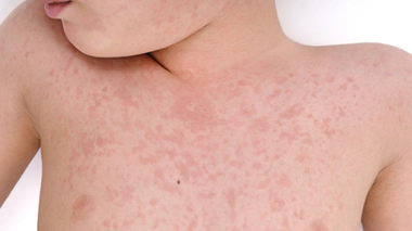 La rougeole court toujours en France et touche des patients plus âgés