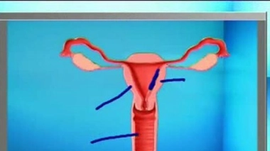 Ch@t : Fausses couches