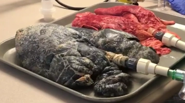 La BPCO tue chaque année plus de 16 000 personnes en France.