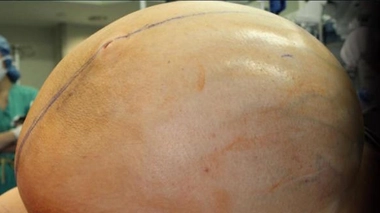 Une Américaine se fait retirer une tumeur ovarienne de près de 60 kg