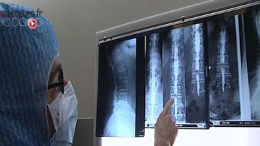 Sténose lombaire : les nerfs comprimés