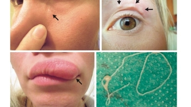 Source : NEJM (doi:10.1056/NEJMicm1716138)