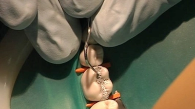 Les plombages au mercure interdits chez les enfants et les femmes enceintes