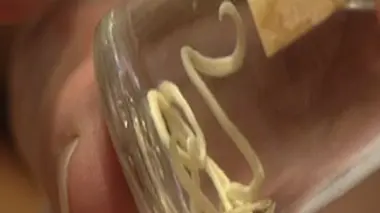 Elle frôle la paralysie à cause d'un ver intestinal