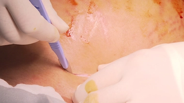 "Il faut sans conteste faciliter l’accès à la césarienne dans les endroits où elle n’est pas assez pratiquée", tempèrent les gynécologues