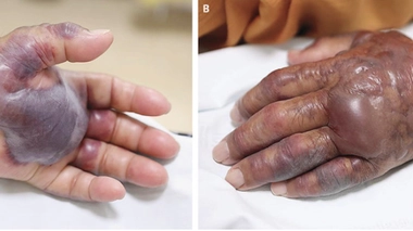 Il mange des fruits de mer crus… et perd sa main gauche